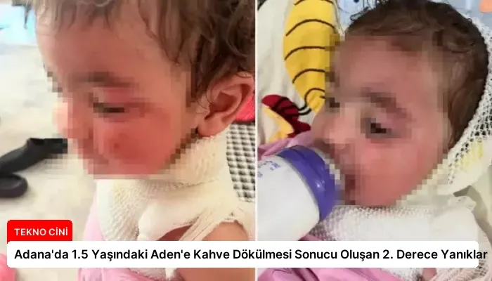 Adana’da 1.5 Yaşındaki Aden’e Kahve Dökülmesi Sonucu Oluşan 2. Derece Yanıklar